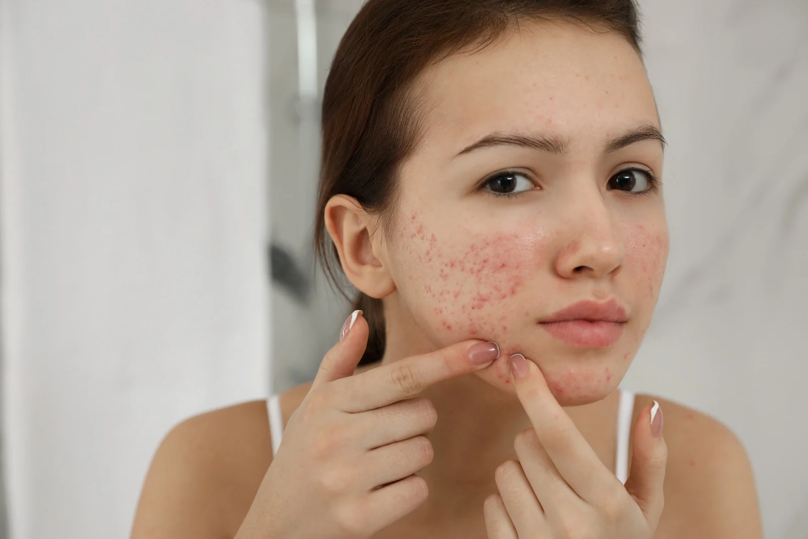 Acné à l'adolescence : pourquoi les boutons apparaissent et comment prendre soin de ta peau